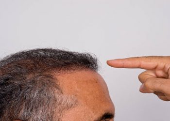 What Is the Best Treatment for Male Hair Loss?