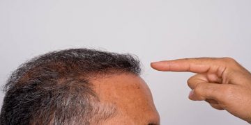 What Is the Best Treatment for Male Hair Loss?