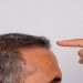 What Is the Best Treatment for Male Hair Loss?