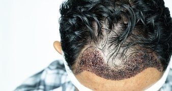 4 Effective Hair Treatment Options for Men