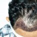 4 Effective Hair Treatment Options for Men