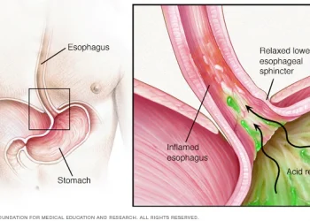 Gastroesophageal Reflux Disease