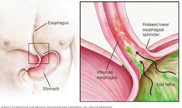 Gastroesophageal Reflux Disease