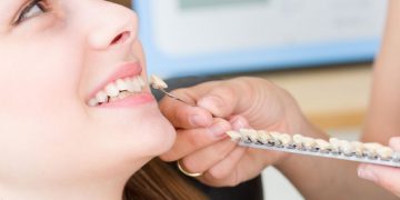 Procedure for the placement of dental veneers