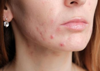 Treat Your Acne Early