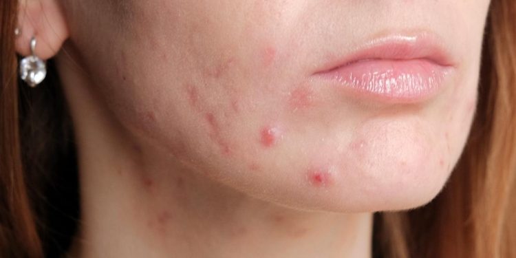 Treat Your Acne Early