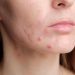 Treat Your Acne Early