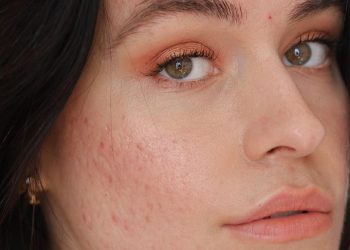 The How's, What's, and Why's of Acne Patches