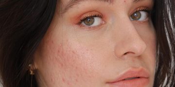 The How's, What's, and Why's of Acne Patches