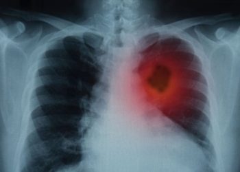 Early Lung Cancer Detection and Screening