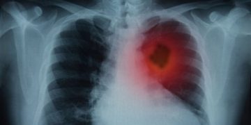 Early Lung Cancer Detection and Screening