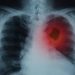 Early Lung Cancer Detection and Screening