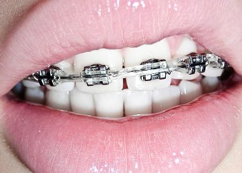 Tips To Maintain Braces