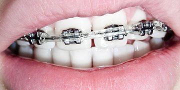 Tips To Maintain Braces