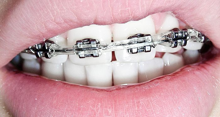 Tips To Maintain Braces