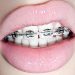 Tips To Maintain Braces