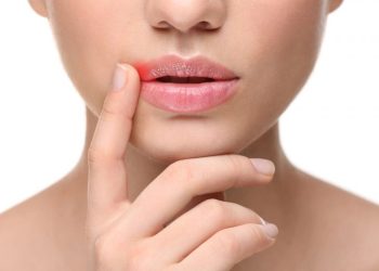 How to Remove a Cold Sore Fast?