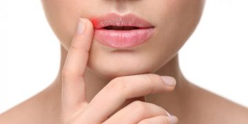 How to Remove a Cold Sore Fast?