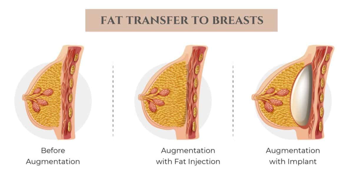 Who is a Candidate for Implant or Filler?