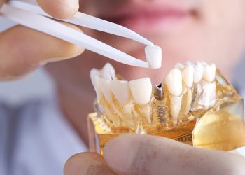 Why Dental Implants Are Essential for Your Oral Health