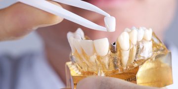 Why Dental Implants Are Essential for Your Oral Health