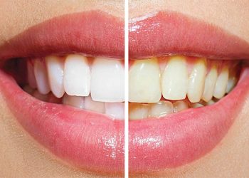 How Long Does Teeth Whitening Last?