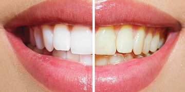 How Long Does Teeth Whitening Last?