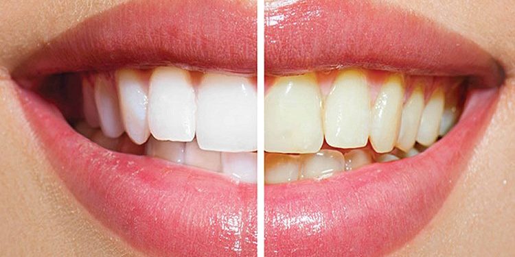 How Long Does Teeth Whitening Last?