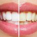 How Long Does Teeth Whitening Last?