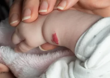 Salmon Patch - What you need to  know?