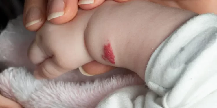 Salmon Patch - What you need to  know?