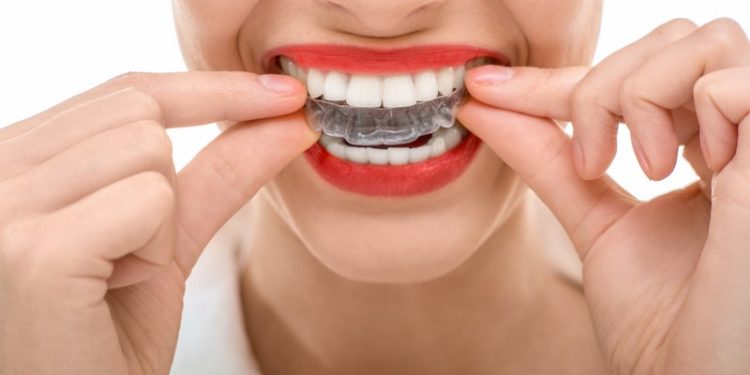 The Complete Guide on How Invisalign Works