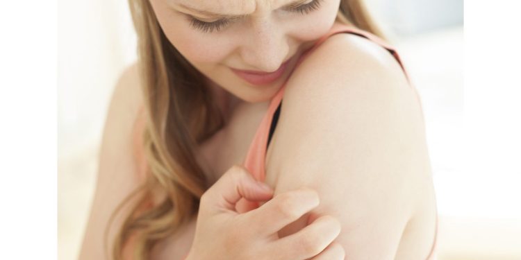 How to Deal with Psoriasis and Eczema Flare-ups in Winter