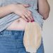 5 Tips for Living with an Ostomy