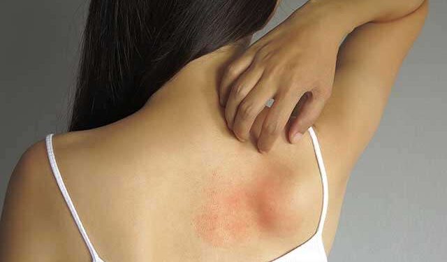 3 Ways To Prevent and Manage Allergic Reactions