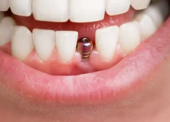 What To Expect When Getting Dental Implants