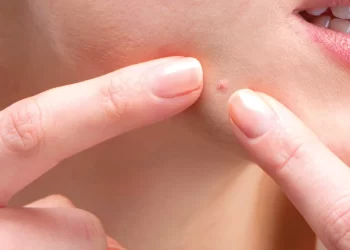 Skin Resolutions To Prevent Acne Breakouts