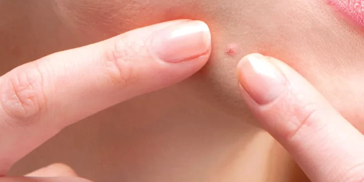 Skin Resolutions To Prevent Acne Breakouts