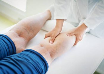 Minimally Invasive Treatment for Varicose Veins: Radiofrequency Ablation (RFA)