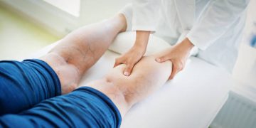 Minimally Invasive Treatment for Varicose Veins: Radiofrequency Ablation (RFA)