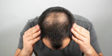Health Care Focus: Female to Male Hair Transplants