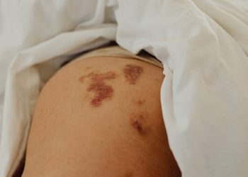 Bid Farewell to Inner Thigh Chafing by Utilizing the Effectiveness of Thigh Bands