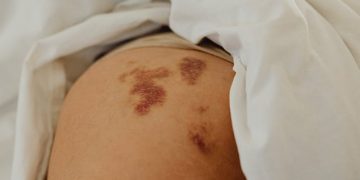 Bid Farewell to Inner Thigh Chafing by Utilizing the Effectiveness of Thigh Bands