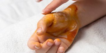 Bouncing Back After a Personal Injury: Tips and Strategies