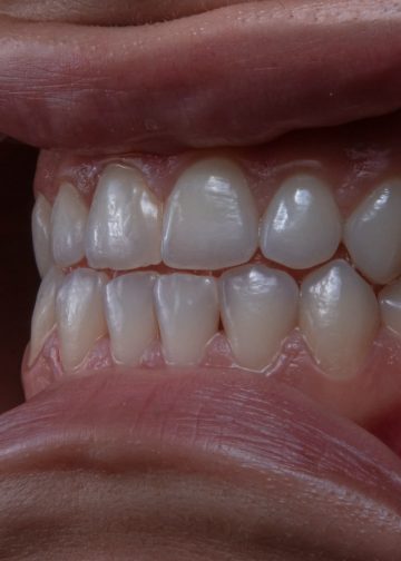 Early Warning Signs of Gingivitis: What Your Gums May Be Telling You
