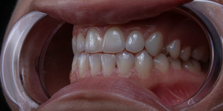 Early Warning Signs of Gingivitis: What Your Gums May Be Telling You