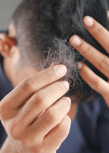 Minoxidil Purge Shedding: Signs, Timeline, and When to Worry